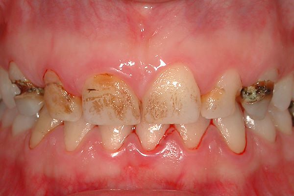 Caso iniziale-La paziente giunge alla nostra attenzione con un problema estetico molto importante. Gli elementi dentali risultano cariati con presenza di placca e tartaro