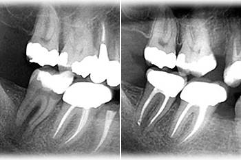 Trattamento canalare endodontico di dente necrotico