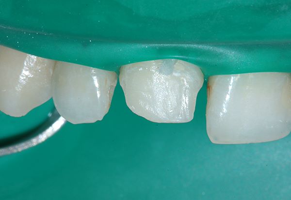 Aspetto della cavità dopo la rimozione della precedente otturazione e della dentina contaminata