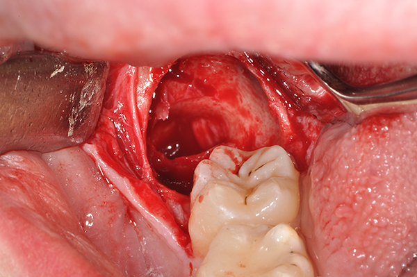 Alveolo post-estrattivo: si noti il nervo alveolare in posizione linguale rispetto al dente come evidenziato dalla TAC pre-intervento