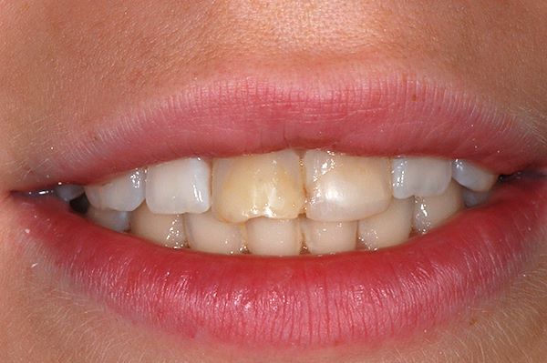 La paziente non è soddisfatta del suo sorriso e vuole migliorare la forma e il colore dei suoi denti  È presente un’evidente gengivite e dopo una seduta di igiene orale ed un’adeguata istruzione può cominciare un trattamento ricostruttivo