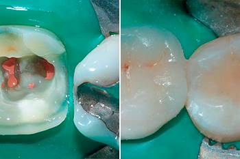 Ricostruzione post endodontica a ricopertura cuspidale totale diretta