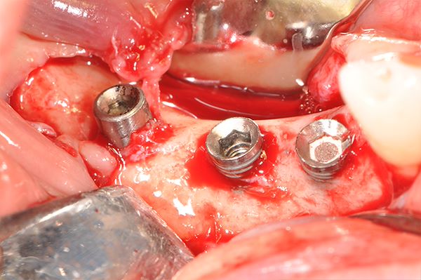 Cresta ossea con esposizione del corpo implantare  impianti inutilizzabili per frattura vite protesica e filettatura interna alla testa dell’impianto