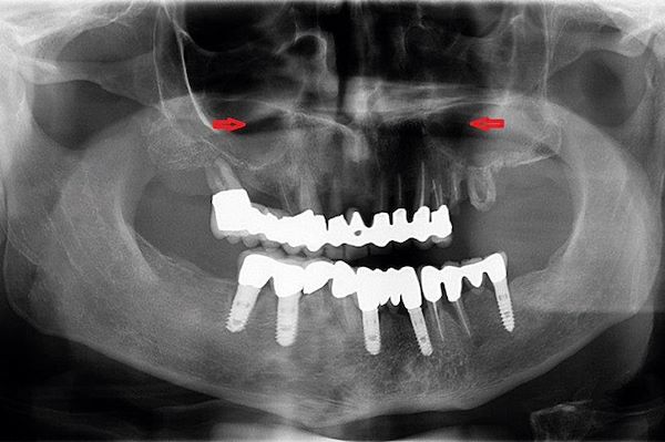 Denti affetti da parodontite e insufficienza d’osso nei settori posteriori come indicato dalle frecce nell’OPT