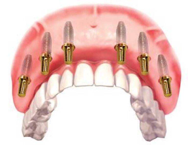 Le fasi dell’intervento di implantologia dentale a carico immediato