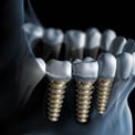 Implantologia Dentale a Carico Immediato