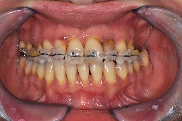 Apparecchiatura multibrackets vestibolare in ceramica