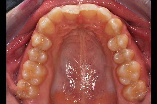 Arcata superiore dopo il trattamento