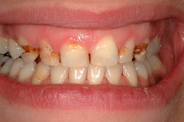 Dopo istruzione all’igiene orale e alcune sedute con l’igienista dentale la paziente può cominciare il piano di cura: vengono in primo luogo trattate le carie con delle otturazioni   