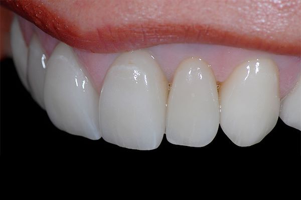 I denti e le gengive sono integrati in modo naturale