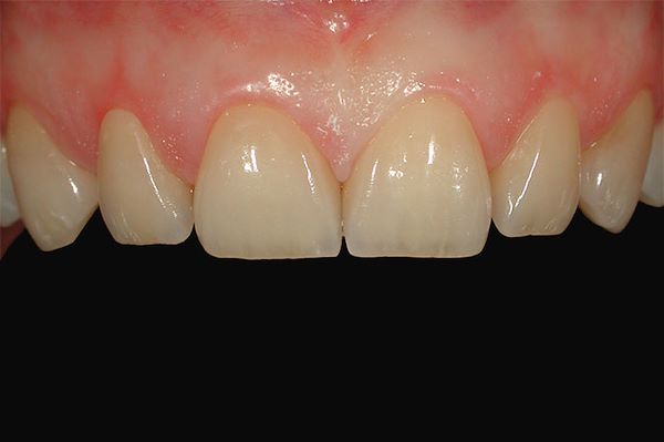 Le faccette sono cementate in modo adesivo, diventando una cosa sola con il dente, rendendo il risultato estetico molto gradevole