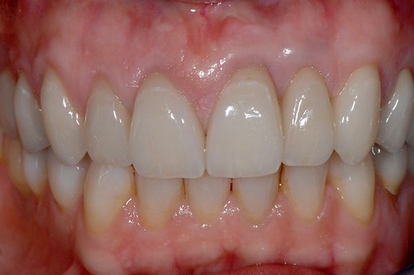 Il lavoro cementato adesivamente dente per dente in ceramica integrale