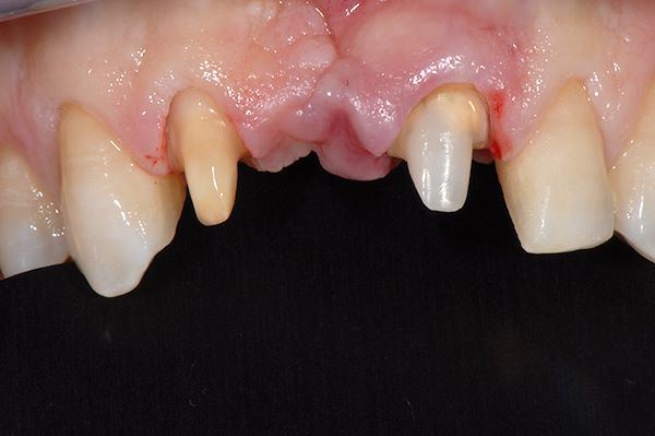 Una volta ripristinati gli elementi di ponte si procede con un intervento gengivale per migliorare la cicatrice dove manca il dente
