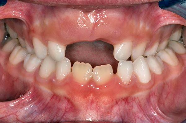 Intraorale frontale prima della terapia
