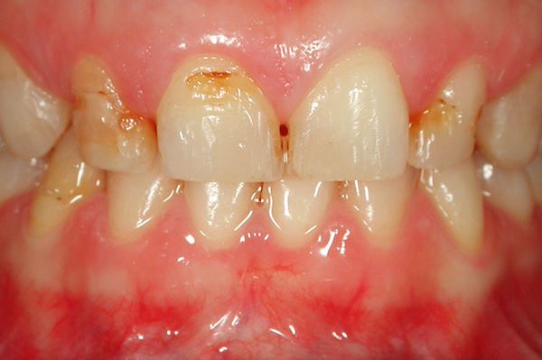 A questo punto possiamo proporre alla paziente delle faccette in ceramica integrale da canino a canino che permetteranno di migliorare la forma e il colore del sorriso, come un nuovo smalto, che renderà più resistenti i denti naturali