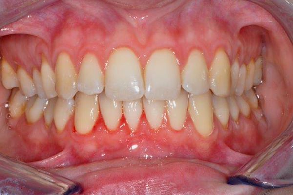 Parodontite cronica: ossia perdita di osso di sostegno dei denti causata principalmente da scarsa igiene orale domiciliare, fumo, diabete e predisposizione genetica. Dalla fotografia si possono osservare aumento del volume gengivale, rossore gengivale e a