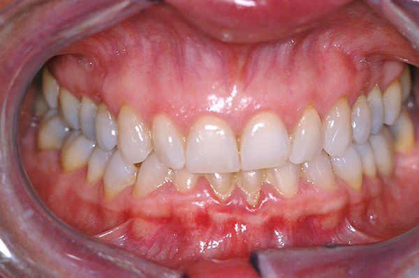 Parodontite cronica: ossia perdita di osso di sostegno dei denti causata principalmente da scarsa igiene orale domiciliare, fumo, diabete e predisposizione genetica. Dalla fotografia si possono osservare aumento del volume gengivale, rossore gengivale e a