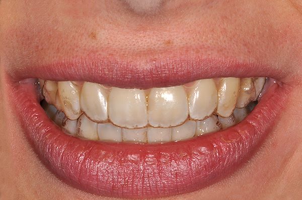 Paziente con in bocca Invisalign