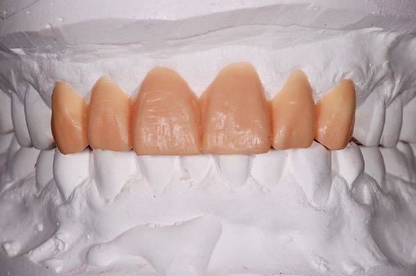 L’odontotecnico insieme all’odontoiatra realizza il progetto di ricostruzione della bocca della paziente