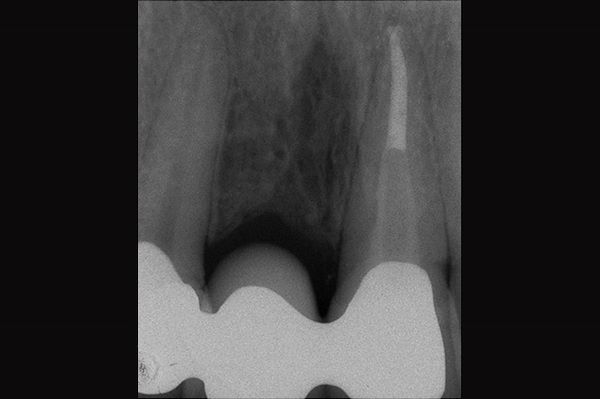 Le radiografie di controllo mostrano la corretta esecuzione del lavoro