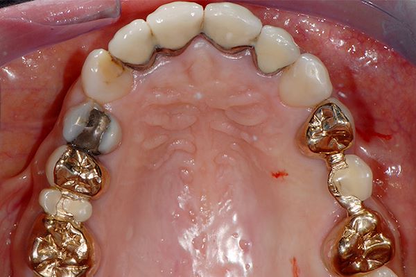 Tutti i restauri in metallo presenti nella bocca oggi si possono realizzare in materiale estetico