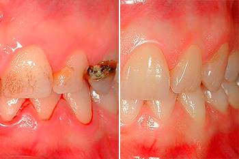 Riabilitazione sei incisivi frontali con faccette in ceramica integrale