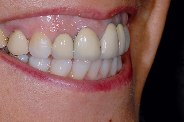 Quando la paziente sorride mostra in modo evidente la parte gengivale e il rapporto tra dente e gengiva è esteticamente importante