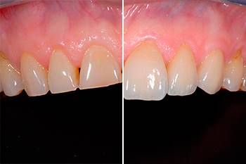 Ricostruzione di denti usurati con ceramica integrale