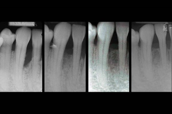 Profondo difetto infraosseo pre e post terapia rigenerativa con amelogenine