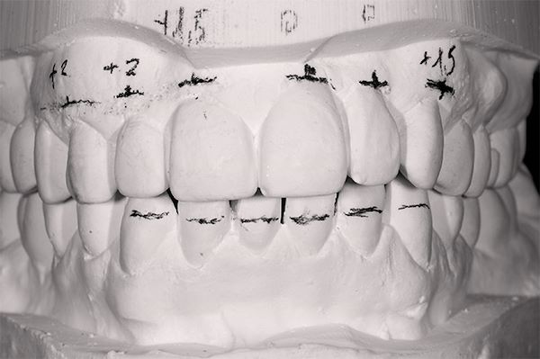 Prima di eseguire il lavoro viene fatto uno studio fotografico e con i modelli in gesso per decidere come eseguire le modifiche dentali e come riequilibrare con un intervento le forme delle gengive