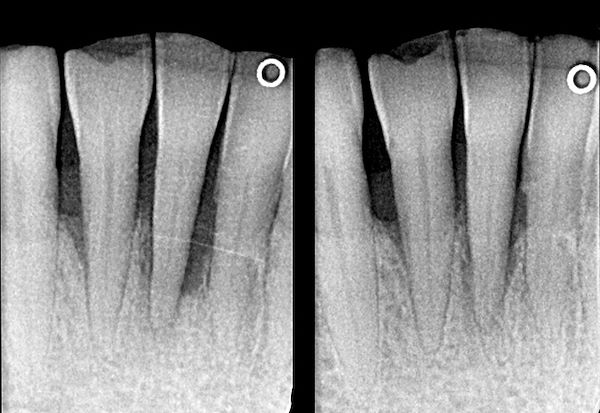 Eseguita l’rx si riscontra un evidente riassorbimento osseo di origine infiammatoria parodontale (rx 1) con tasca di 7 mm