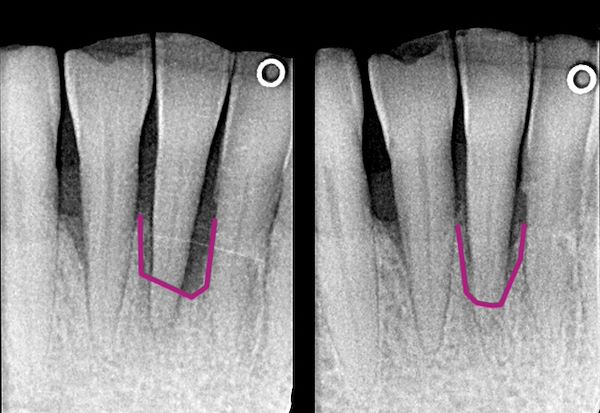 Il paziente è stato sottoposto a sedute di igiene orale approfondite e istruito sulle corrette manovre di igiene orale domiciliare