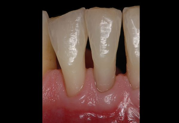 Questo ha portato alla completa risoluzione dell’infiammazione gengivale e alla quasi totale rimineralizzazione dell’osso circostante diminuendo sensibilmente la mobilità del dente senza la necessità di eseguire interventi chirurgici parodontali (rx 2)