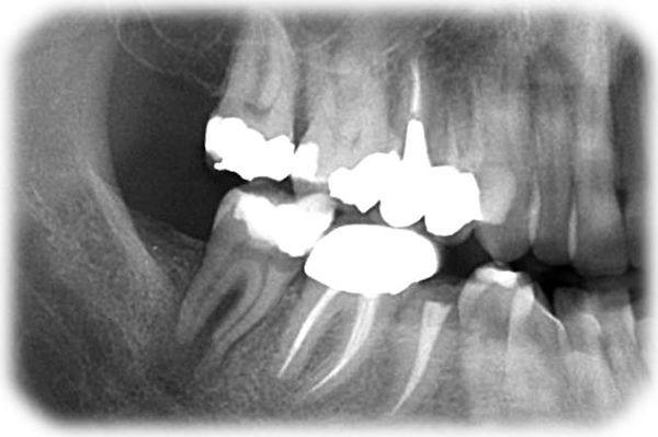 Radiografia endorale: granuloma periapicale di elemento dentale 47 con anatomia radicolare complessa