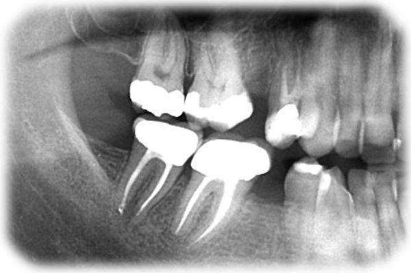 Dopo 6 mesi - Trattamento endodontico: si noti la completa guarigione periapicale e il riassorbimento del granuloma