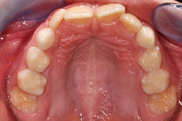Arcata superiore prima del trattamento