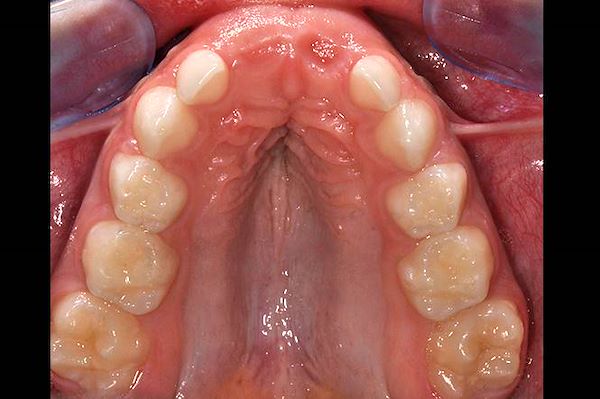 Arcata superiore, palato stretto e ogivale prima dell’espansione