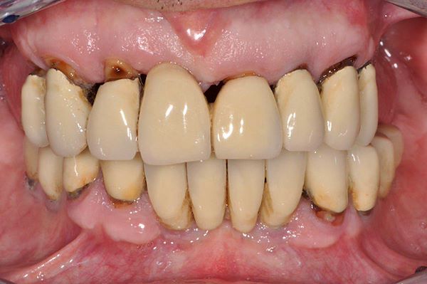 Foto del sorriso: si notino carie radicolari e perdita d’osso causata da parodontite