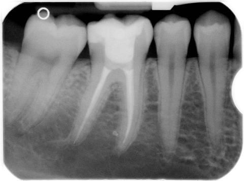 Radiografia finale con terapia canalare completata e restauro coronale in resina composita.