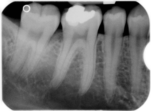 Il primo molare inferiore di destra (4.6) presenta sintomatologia pulpitica e un’otturazione in amalgama infiltrata.  Si procede a devitalizzazione dell’elemento.   