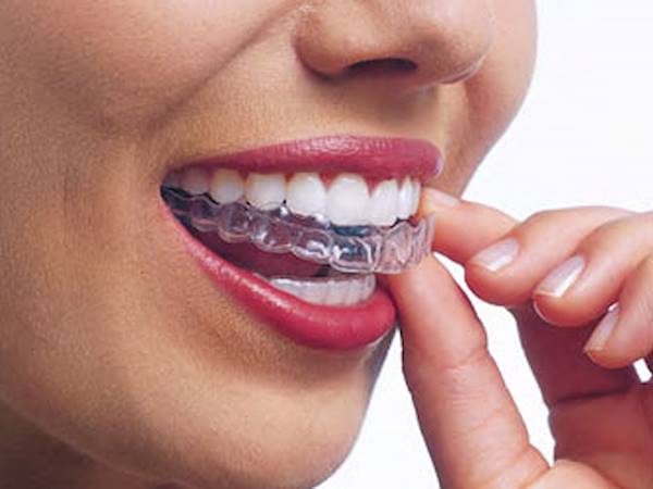 Ortodonzia Invisibile Invisalign