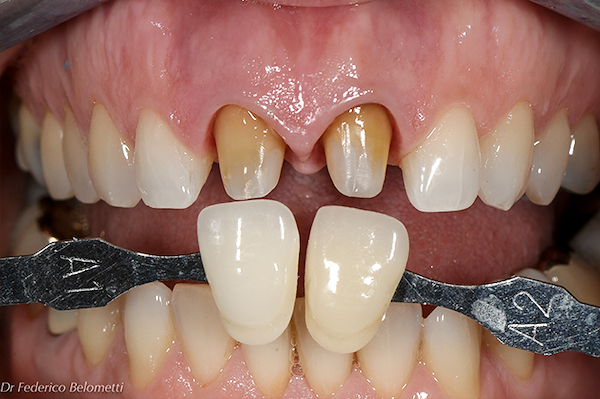 Osserviamo qui le corone definitive in disilicato di lito (materiale estetico e resistente, completamente privo di metallo) una volta cementate definitivamente con cementazione adesiva. Possiamo valutare l’integrazione estetica con gli elementi dentali na