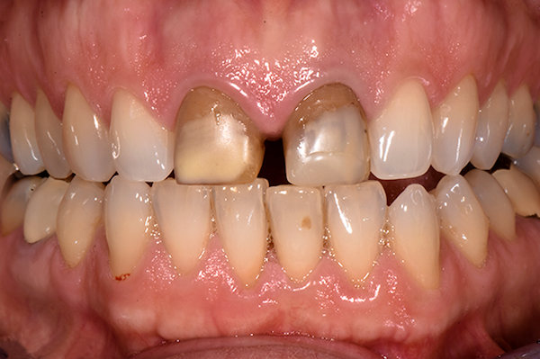 Dal punto di vista della morfologia, gli incisivi centrali, si presentano di dimensioni troppo ridotte, sia in senso verticale che orizzontale con un importante diastema centrale, contribuendo alla disarmonia estetica dell’insieme.