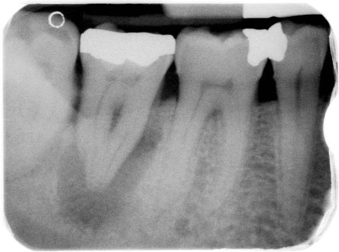 Terapia canalare del 2° molare inferiore di destra (4.7): l’elemento non è vitale, presenta un ascesso con fistola e la radiografia iniziale mostra un’estesa lesione periradicolare.  Radiografia intra-operatoria: lunghezza di lavoro dei canali radicolari.