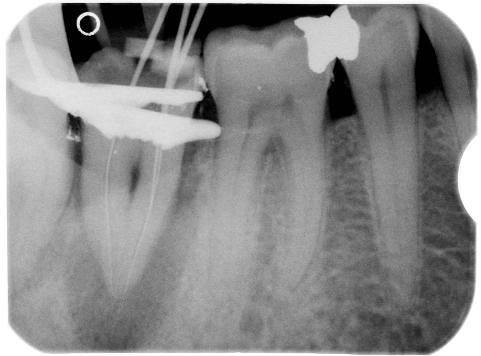 Radiografia intra-operatoria: prova dei coni di guttaperca.