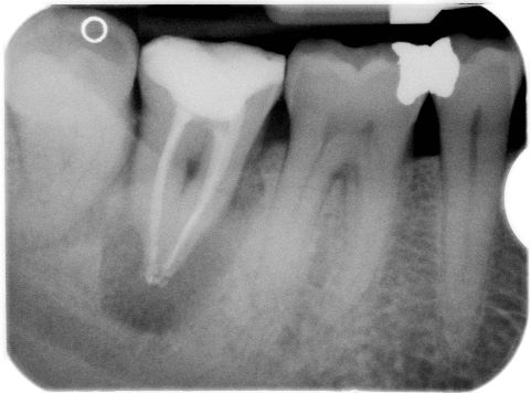 Radiografia finale: terapia endodontica con riempimento tridimensionale dei canali radicolari con guttaperca.