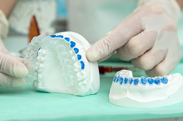 Mascherine dentali in gomma realizzate su modello delle arcate dentarie della paziente; tali mascherine si utilizzano per continuare il trattamento sbiancante domiciliare con prodotto sbiancante “Opalescence” al 10%