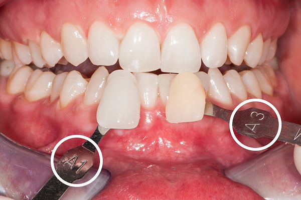 Risultato finale post-sbiancamento. Si noti la differenza tra colore iniziale A3 e colore finale A1; si è ottenuto un miglioramento di due tonalità di colore