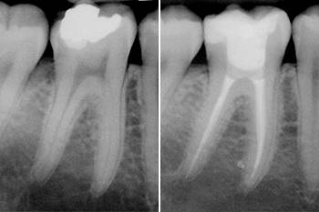 Terapia canalare di elemento dentale 46