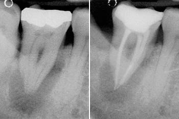 Terapia canalare di elemento dentale 47